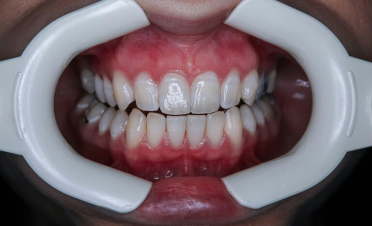 Ästhetische Zahnmedizin : Bleaching