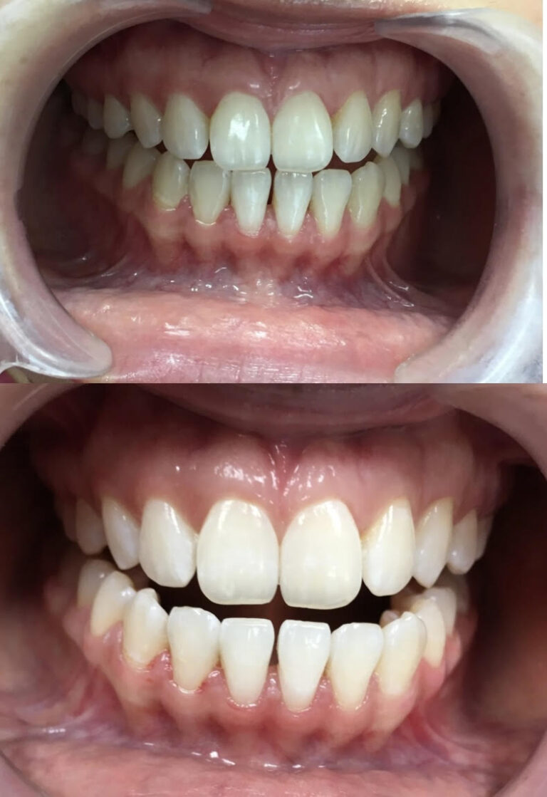 bleaching XungiZang